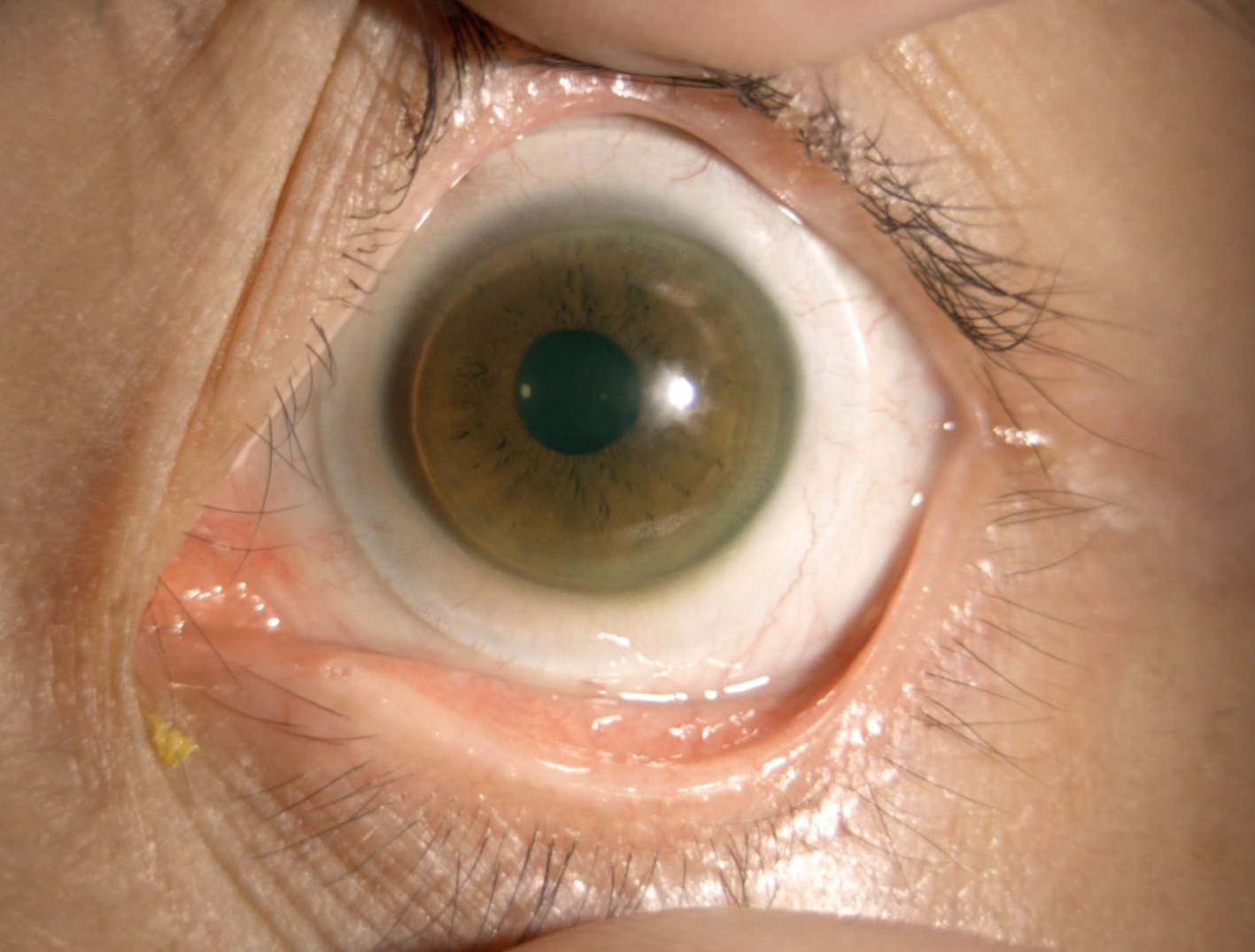 Scleral contact lens for severe dry eye